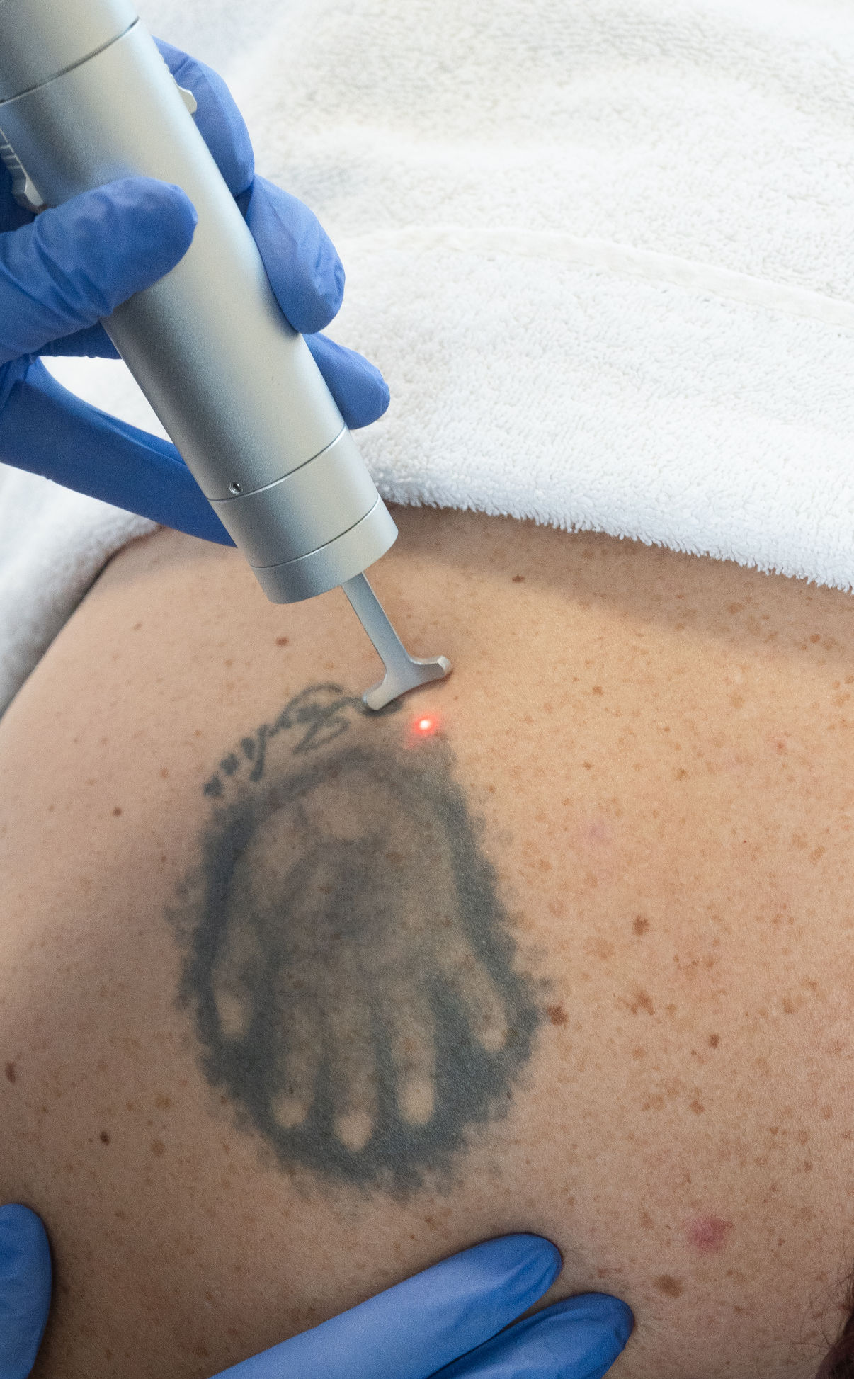Tattoo verwijderen met laser